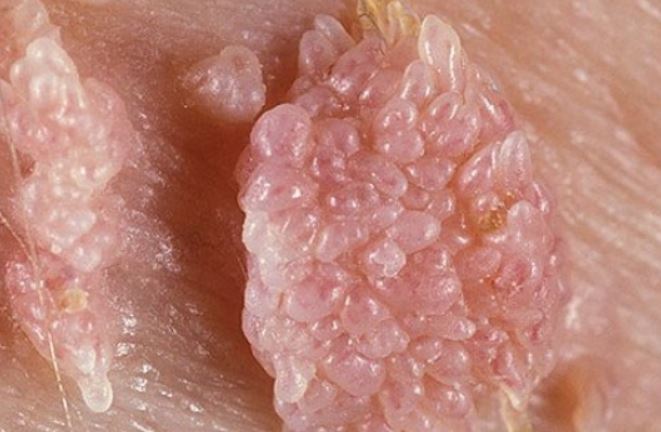 Genital Siğil Tedavi Fiyatları